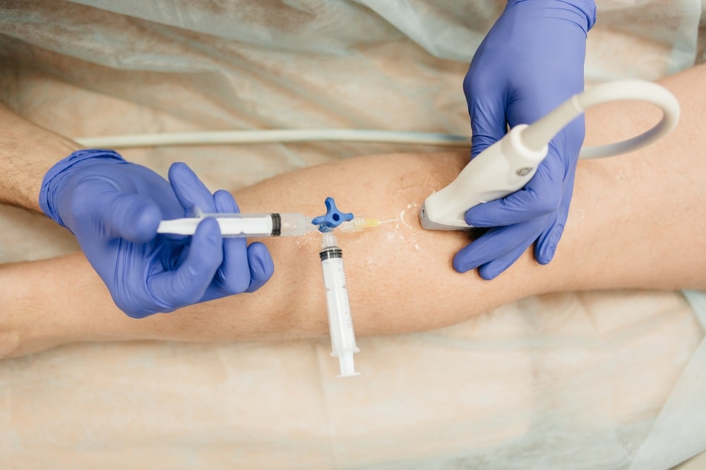 Доктор проводит пенную склеротерапию