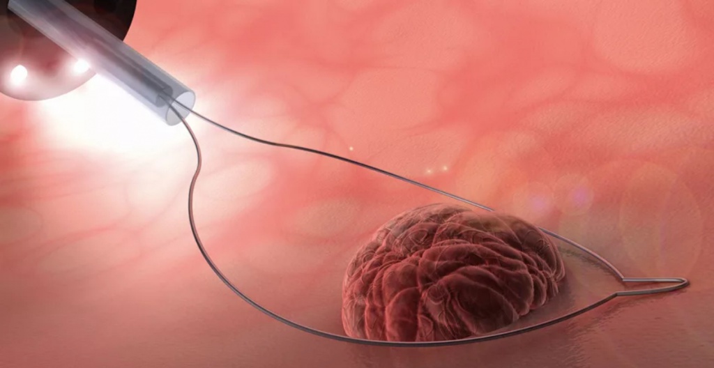 Процесс лечения полипа